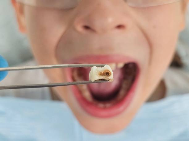 Best Emergency Dentist for Lost Fillings or Crowns in Bloomfield, IN